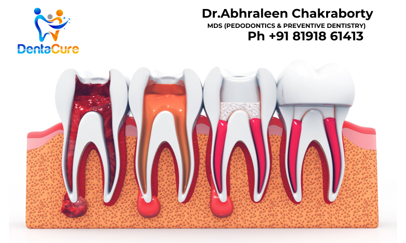 rct root canal near tollygunge