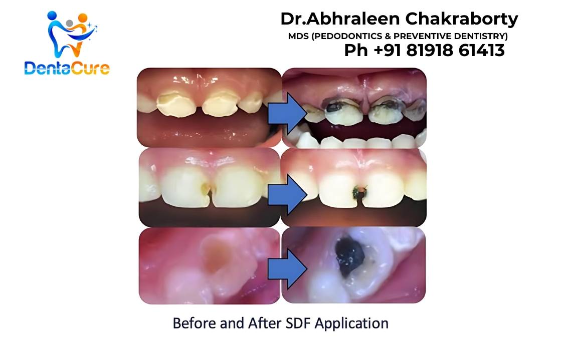 sdf application in child tooth